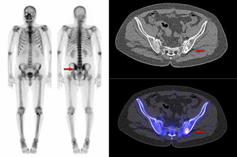 Radioisotypes for cancer diagnostics and therapy